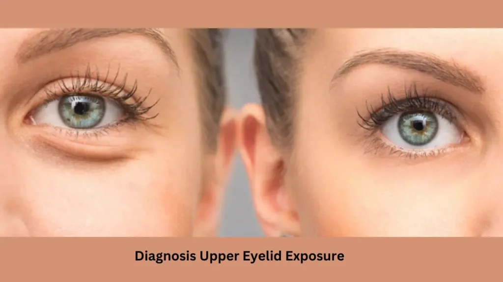 Diagnosis Upper Eyelid Exposure