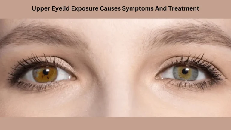 Upper Eyelid Exposure